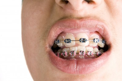 Caring for Oral Braces-8605