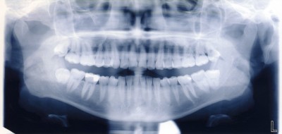 Do dental X-rays increase the risk of cancer?-9259