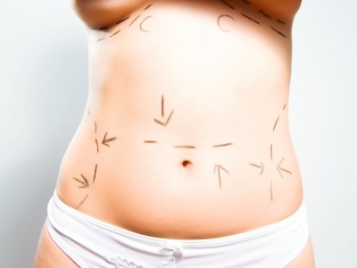 New Year’s Resolution – Tummy Tuck-9937