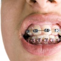 Caring for Oral Braces-8605