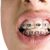 Caring for Oral Braces-8605