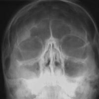 Support Following A Traumatic Brain Injury-0040