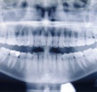 Do dental X-rays increase the risk of cancer?-9259