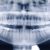Do dental X-rays increase the risk of cancer?-9259