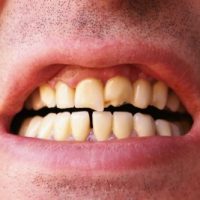 Shortage Of Patients For Dental Students-7547