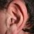 New Cosmetic Surgery Procedure to Reverse Stretched Earlobes-2593