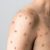 New guidelines encourage monkeypox contacts to isolate for 21 days